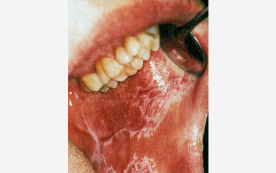 Forme hyperkératosique dendritique en feuille de fougère