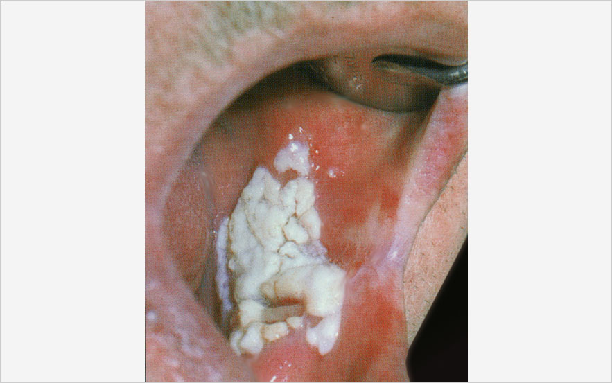 Papillomatose orale floride de la face interne de la joue