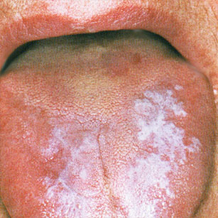 hyperkératosique en plaque de la langue