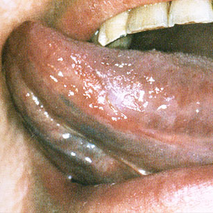 Kératose frictionnelle du bord de la langue