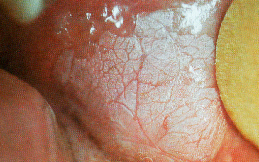 Leucoplasie homogène de la face interne de la joue