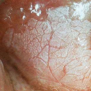 Leucoplasie homogène de la face interne de la joue
