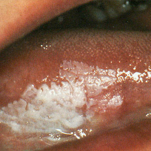 Leucoplasie verruqueuse de la face ventrale de la langue