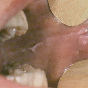 Linea alba ou ligne occlusale de la joue