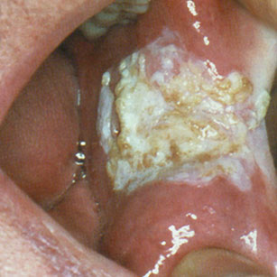 Papillomatose orale floride de la région rétrocommissurale 