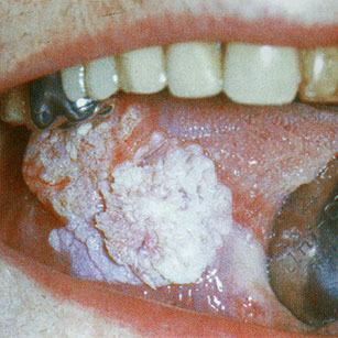 Papillomatose orale floride du bord droit de la langue