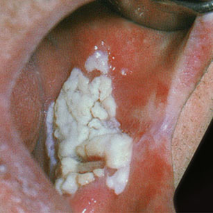 
Papillomatose orale floride de la face interne de la joue