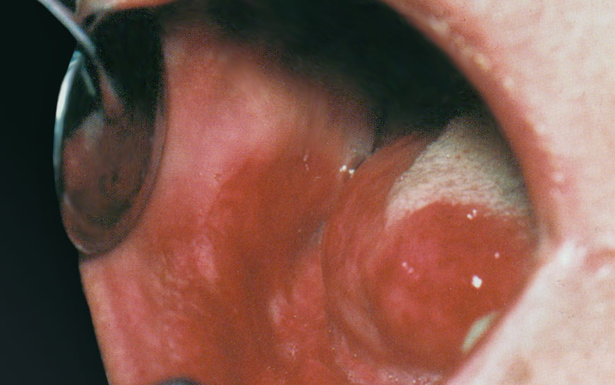 Erythroplasie de la langue