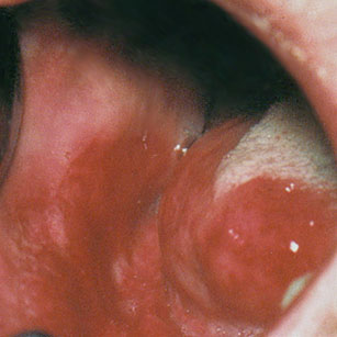 Erythroplasie de la langue