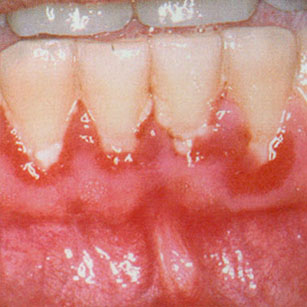Lésions érythémateuses bactériennes, gingivite, parodontite, plaque bactérienne