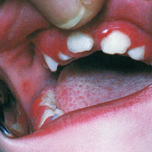 Gingivostomatite d’éruption dentaire