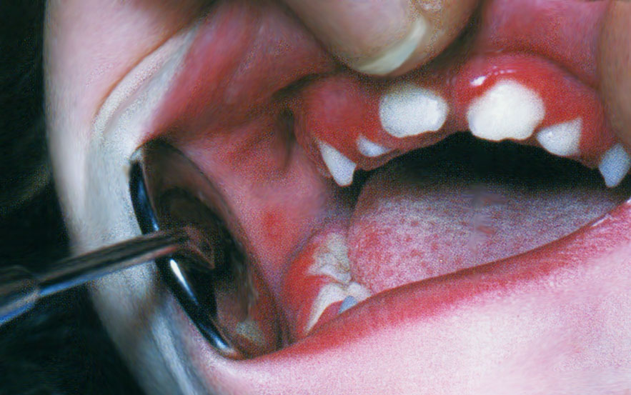 Gingivostomatite d'éruption dentaire