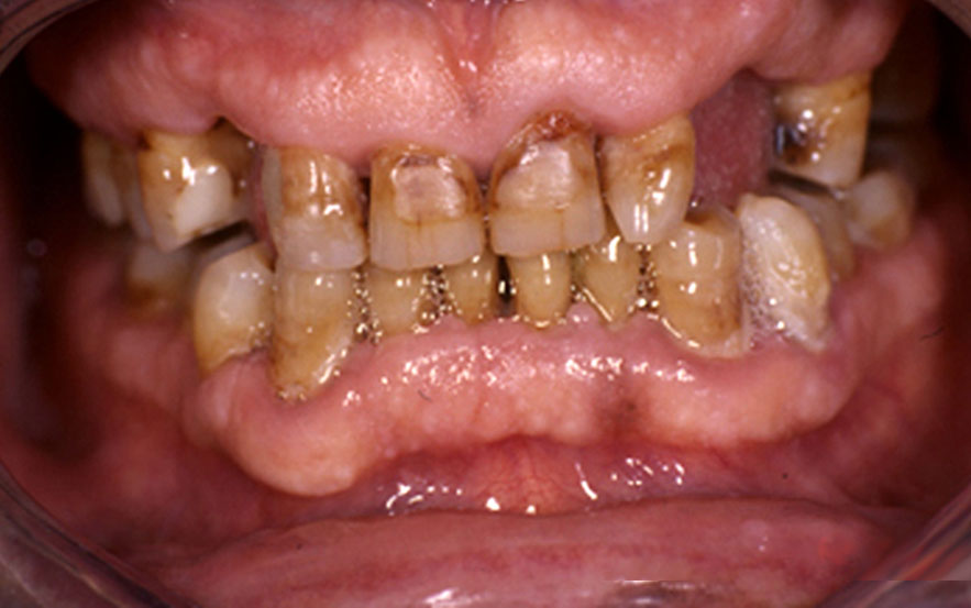 Hypertrophies gingivales idiopathiques