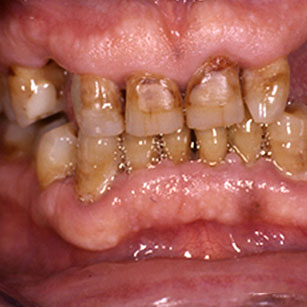 Hypertrophies gingivales idiopathiques